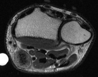 Figure 3 for case Flexor carpi radialis tendon laceration ( RID2388 )